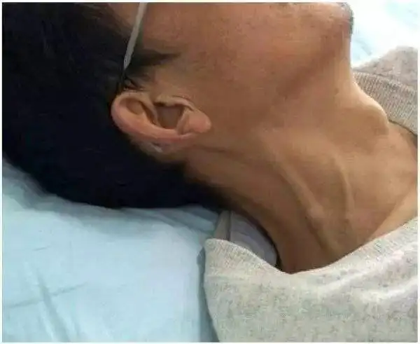 脖子上这条血管一旦出现说明心脏不好
