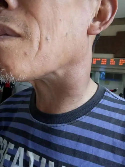 颈部鼓包正好在大动脉,现在医院没检查结果