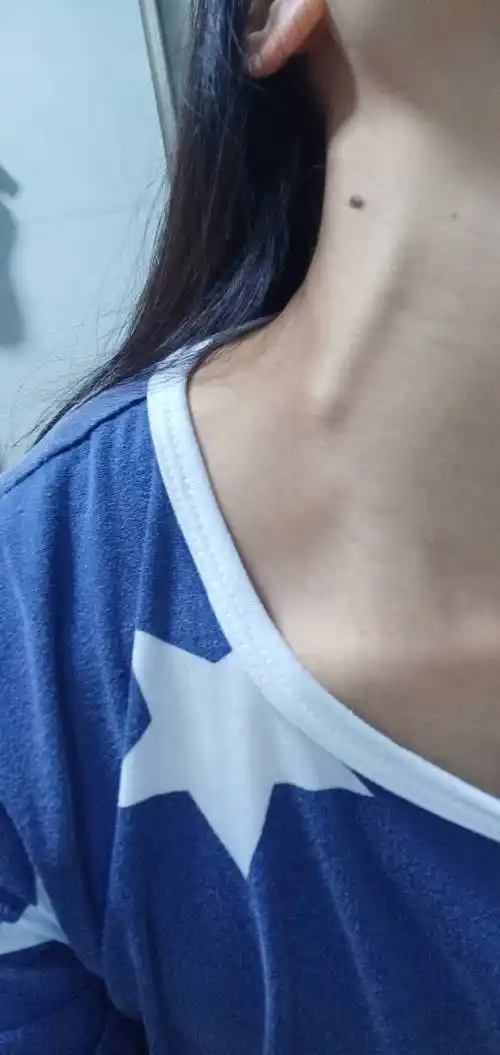 如图下 脖子上动脉突然变粗了 但没什么异常不舒服