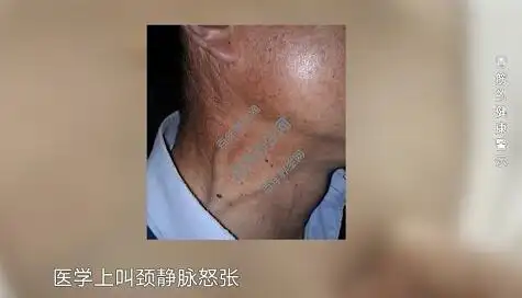 20220223x诊所视频和笔记竺挺青筋动脉硬化颈静脉怒张肝病