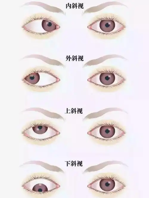 导致急性共同性的内斜视有几个原因.