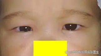 最容易误认为是内斜,也是假性斜视中最多见的一种类型.